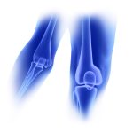Knee and elbow orthopedic implants